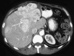 Vascular Islet Cell Tumor of the Pancreas With Hypervascular Metastases - CTisus CT Scan