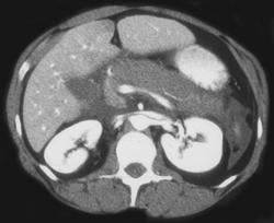 Acute Pancreatitis - CTisus CT Scan