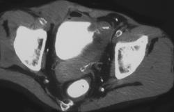 Pancreatic Transplant With Anastomosis to the Bladder - CTisus CT Scan