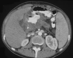 Pancreatic Cancer Invades the Stomach - CTisus CT Scan