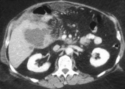 Abscess Following Whipple Procedure - CTisus CT Scan