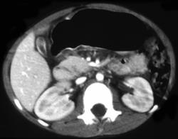 Pancreatic Laceration Following Trauma - CTisus CT Scan