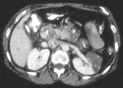 Pancreatic Cancer With Liver Metastases and Renal Infarction - CTisus CT Scan