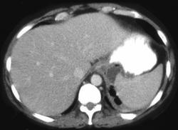 Pancreatic Abscess - CTisus CT Scan