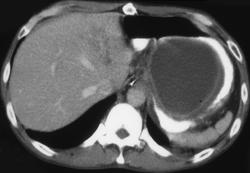 Pseudocyst - CTisus CT Scan