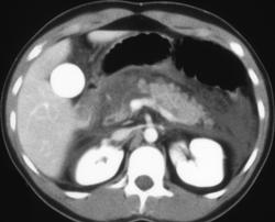 Focal Pancreatic Necrosis - CTisus CT Scan