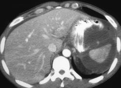 Pseudocysts Surround Spleen - CTisus CT Scan