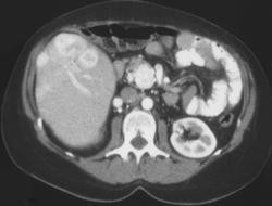 Islet Cell Tumor - CTisus CT Scan