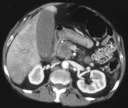 Carcinoma of the Pancreas With Changes in Hepatic Enhancement - CTisus CT Scan