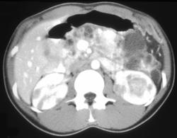 Von Hippel-Lindau syndrome (VHL) With Metastases to the Pancreas From Renal Cell Carcinoma - CTisus CT Scan