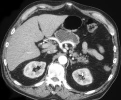 Cystic Pancreatic Neoplasm - Pancreas Case Studies - CTisus CT Scanning