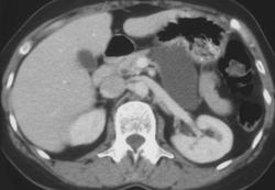 True Pancreatic Cyst - CTisus CT Scan