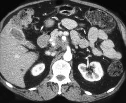 Carcinoma of the Pancreas Encases the Superior Mesenteric Vein (SMV) - CTisus CT Scan