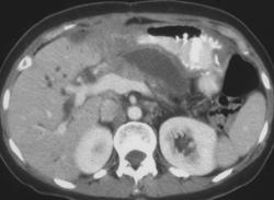 Locally Recurrent Carcinoma of the Pancreas - CTisus CT Scan