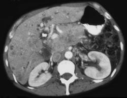 Primary Carcinoid of the Pancreas - CTisus CT Scan