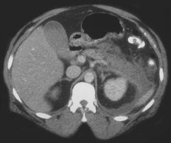 Acute Pancreatitis - CTisus CT Scan