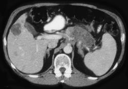 Pancreatic Cancer With Liver Metastases - CTisus CT Scan