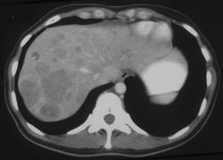 Pancreatic Cancer - CTisus CT Scan