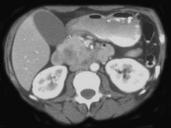 Breast Cancer Metastatic to the Pancreas - CTisus CT Scan