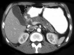 Chronic Pancreatitis - CTisus CT Scan