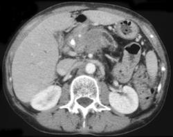 Pancreatic Cancer - CTisus CT Scan