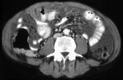 Carcinomatosis Due to Recurrent Pancreatic Cancer - CTisus CT Scan