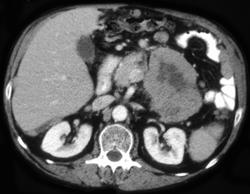 Large Cell Carcinoma of the Pancreas With Carcinomatosis - CTisus CT Scan