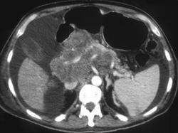 Cystic Pancreatic Neoplasm-(cystadenocarcinoma) - CTisus CT Scan