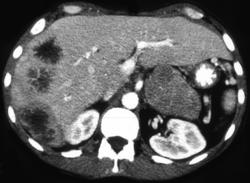 Pancreatic Cancer With Liver Metastases - CTisus CT Scan