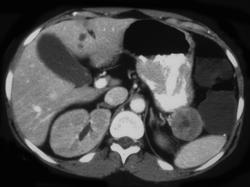 Vipoma of the Tail of the Pancreas - CTisus CT Scan