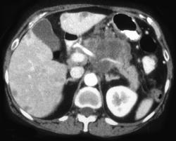 Invasive Carcinoma of the Pancreas - CTisus CT Scan