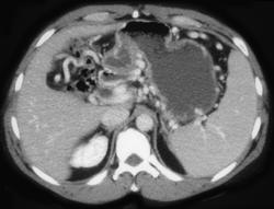 Pseudocyst Occludes Splenic Vein With Collaterals - CTisus CT Scan