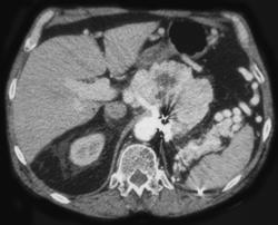 Renal Cell Carcinoma With Metastases to the Pancreas - CTisus CT Scan