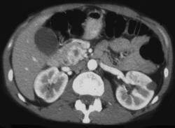 Islet Cell Tumor of the Pancreas in A Patient With Von Hippel-Lindau syndrome (VHL) - CTisus CT Scan