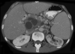 Pancreatitis With Portal Vein Thrombosis - CTisus CT Scan