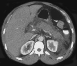 Acute Pancreatitis - CTisus CT Scan