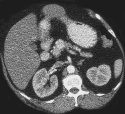 Insulinoma - CTisus CT Scan