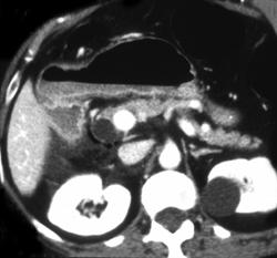 Post-ERCP Pancreatitis - CTisus CT Scan