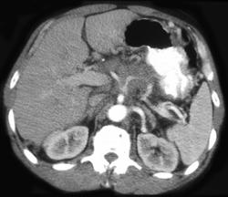 Carcinoma of the Pancreas Invades Celiac-axis & SMA - CTisus CT Scan