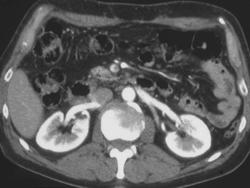 Pseudo-Superior Mesenteric Vein (SMV) Clot - CTisus CT Scan