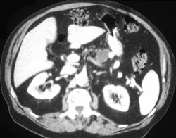 Cystadenoma of the Pancreas - CTisus CT Scan