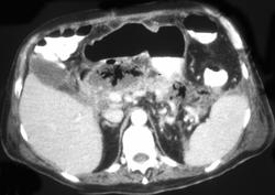 Pancreatic Abscess - CTisus CT Scan