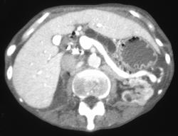 Chronic Pancreatitis With A Dilated Pancreatic Duct - CTisus CT Scan