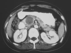 Unusual Islet Cell Tumor of the Pancreas - CTisus CT Scan