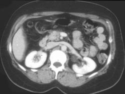 Small Carcinoma of the Pancreas - CTisus CT Scan