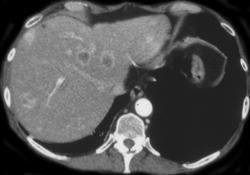 Carcinoid Tumor of the Pancreas With Liver Metastases - CTisus CT Scan