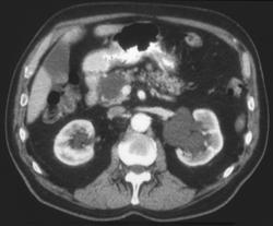 Cystadenoma of the Pancreas - CTisus CT Scan