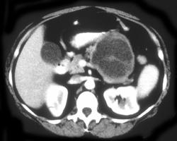 Mucinous Cystadenoma - CTisus CT Scan