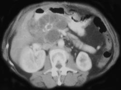 Microcystic Cystadenoma - CTisus CT Scan