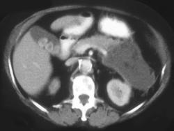 Pancreatitis With Pancreatic Necrosis - CTisus CT Scan